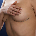 Implantes de mama
