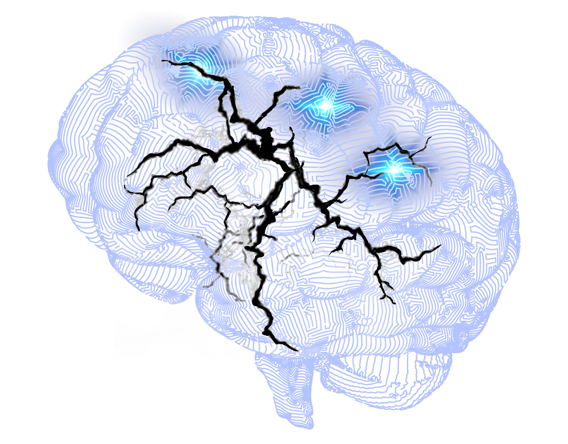 Cerebro Esclerosis Multiple